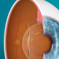 Before and After Photos of ICL Results: A Look at the Success of ICL Procedures