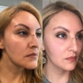 Before and After Photos of LASIK Results: Real Patient Testimonials
