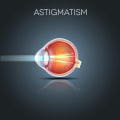 Causes and Symptoms of Astigmatism