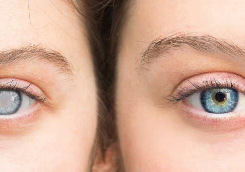 Understanding Cataracts and Treatment Options for Maintaining Eye Health