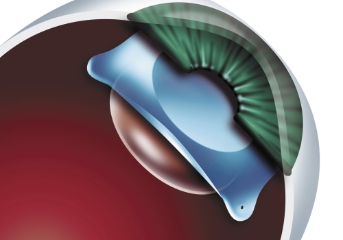 Real-life Experiences of ICL Patients: From Vision Problems to Success Stories